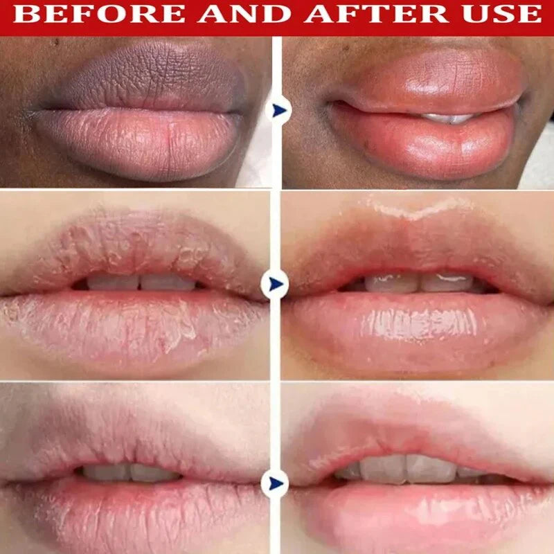 Remove Dark Lip Balm